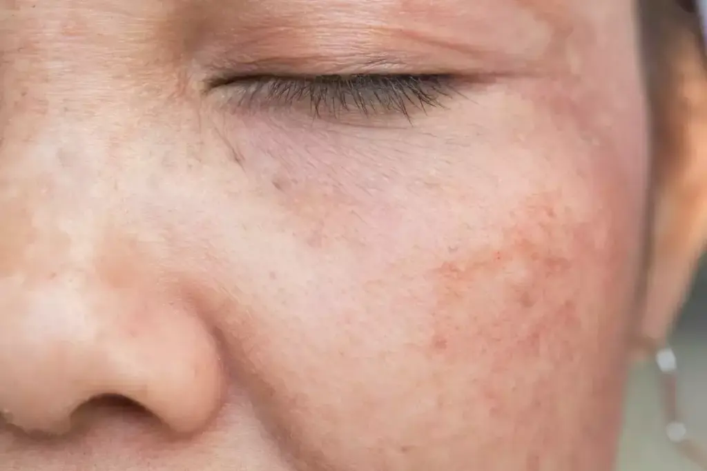 How to Get Rid of Red Spots on Face Naturally