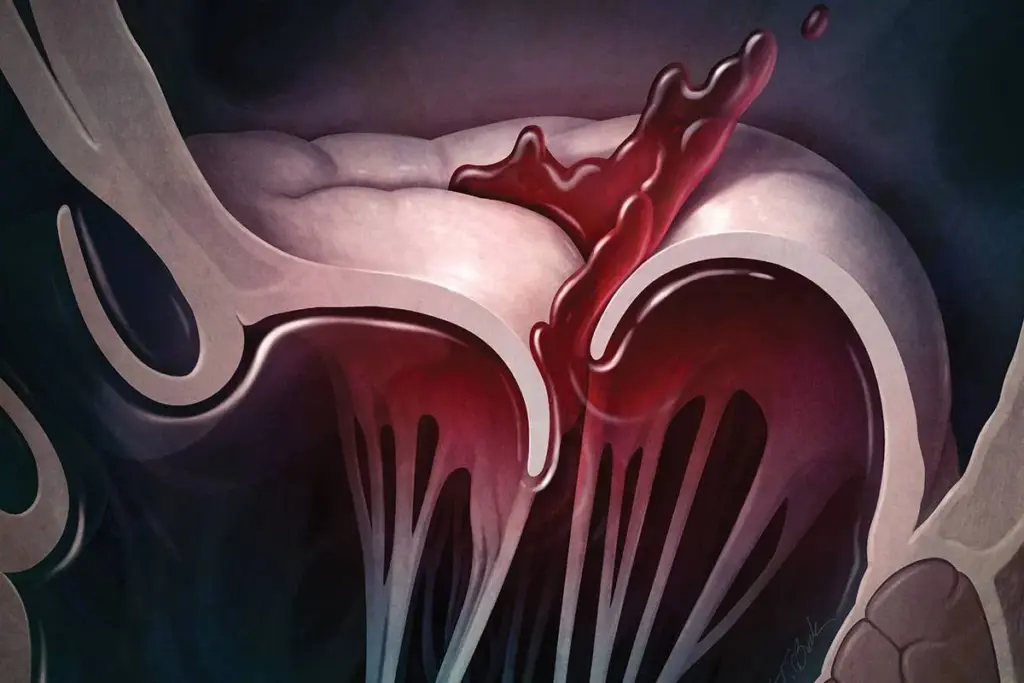 Mitral Valve Clip Candidate: The Crucial Criteria Fact