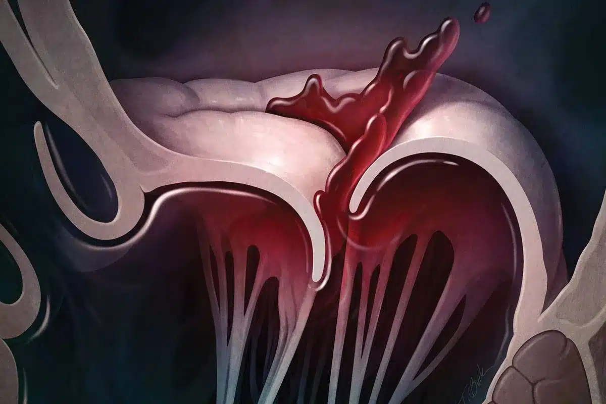 Mitral Valve Clip Candidate: The Crucial Criteria Fact