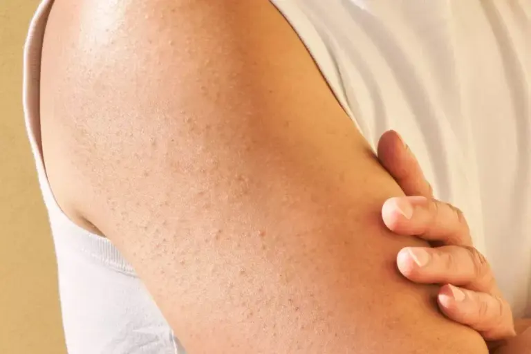How to Get Rid of Cholesterol Bumps on Skin