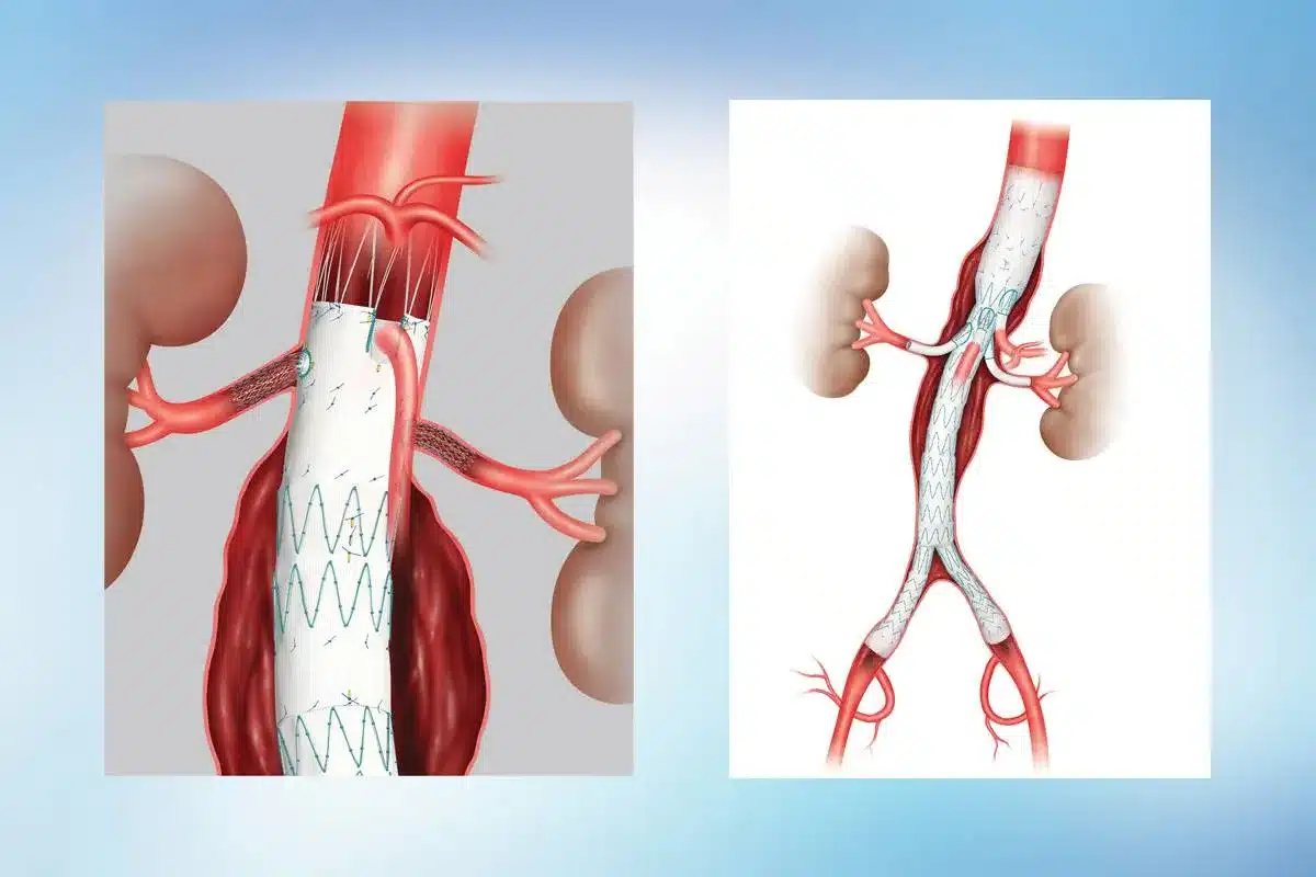 Aortic Stenosis Progression Rate: The Crucial Facts Revealed