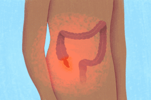 Causes of Appendicitis: 5 Top Triggers