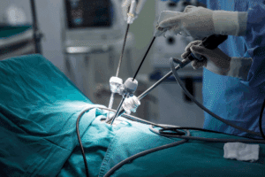 Gas Pain After Laparoscopy Relief: 5 Tips