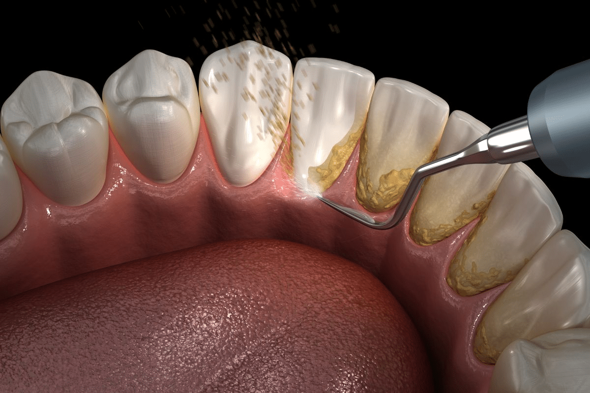 Adenoidectomy School Absence Duration