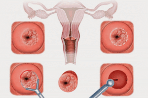 Adenoidectomy Success Rate: Proven Facts