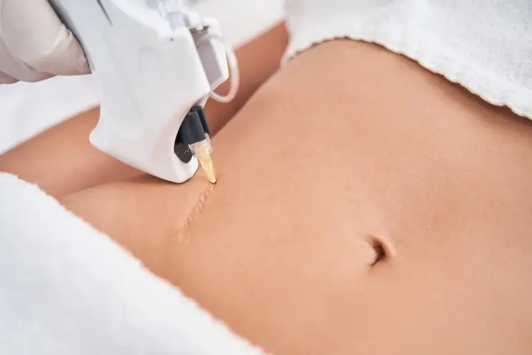 How to Get Face Lasered: Benefits and What to Expect