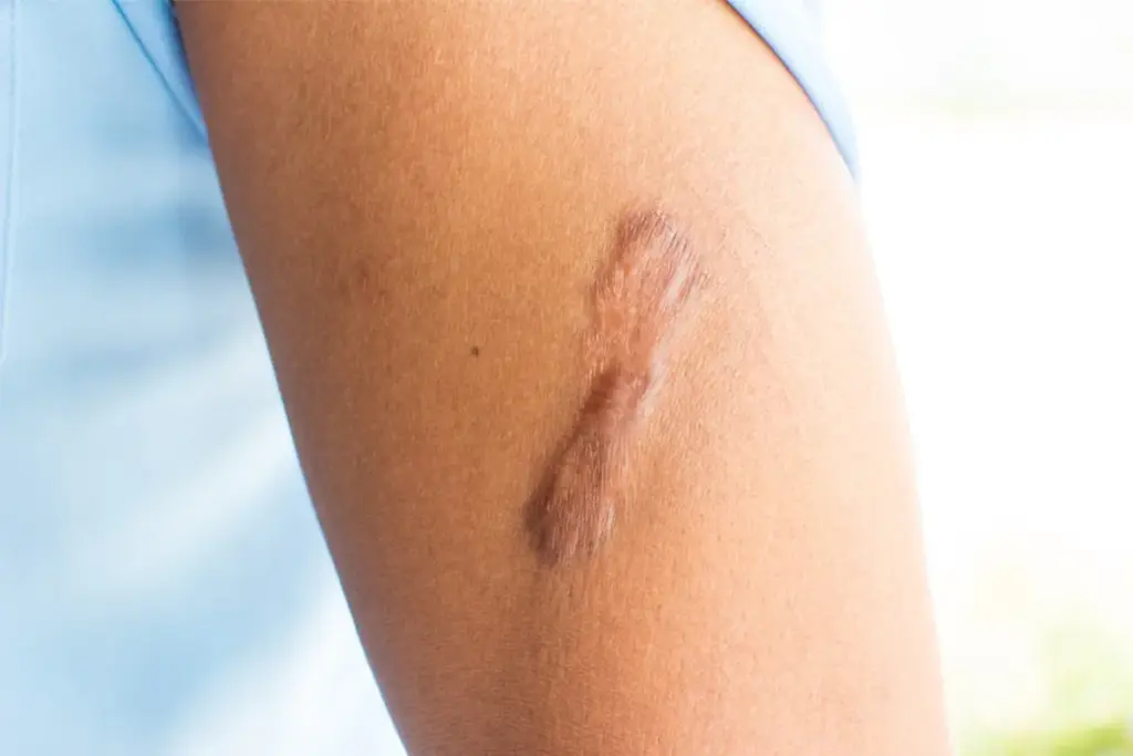 How to Get Rid of Cryotherapy Scars: A Complete Guide