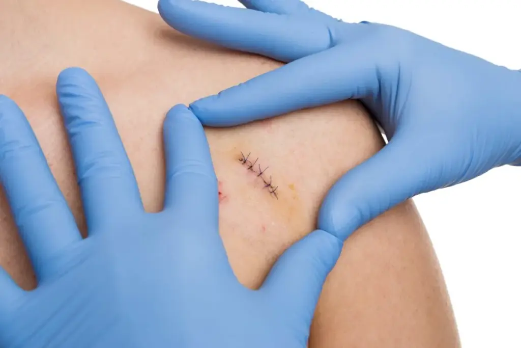 How to Tell if Your Surgical Incision Is Infected