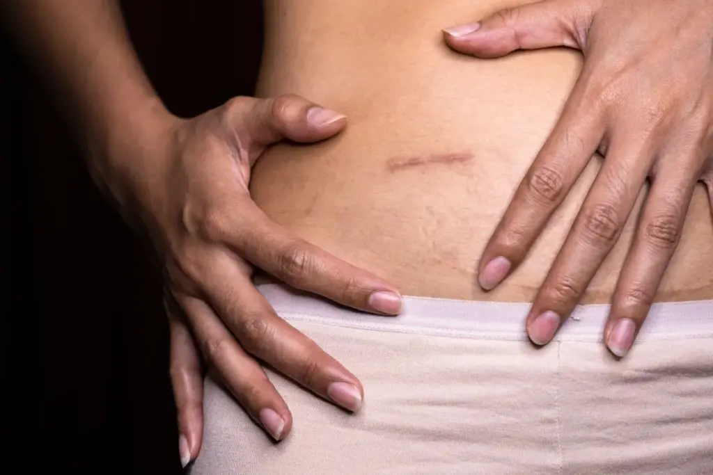 How to Relieve Scar Tissue Pain: 5 Effective Treatments