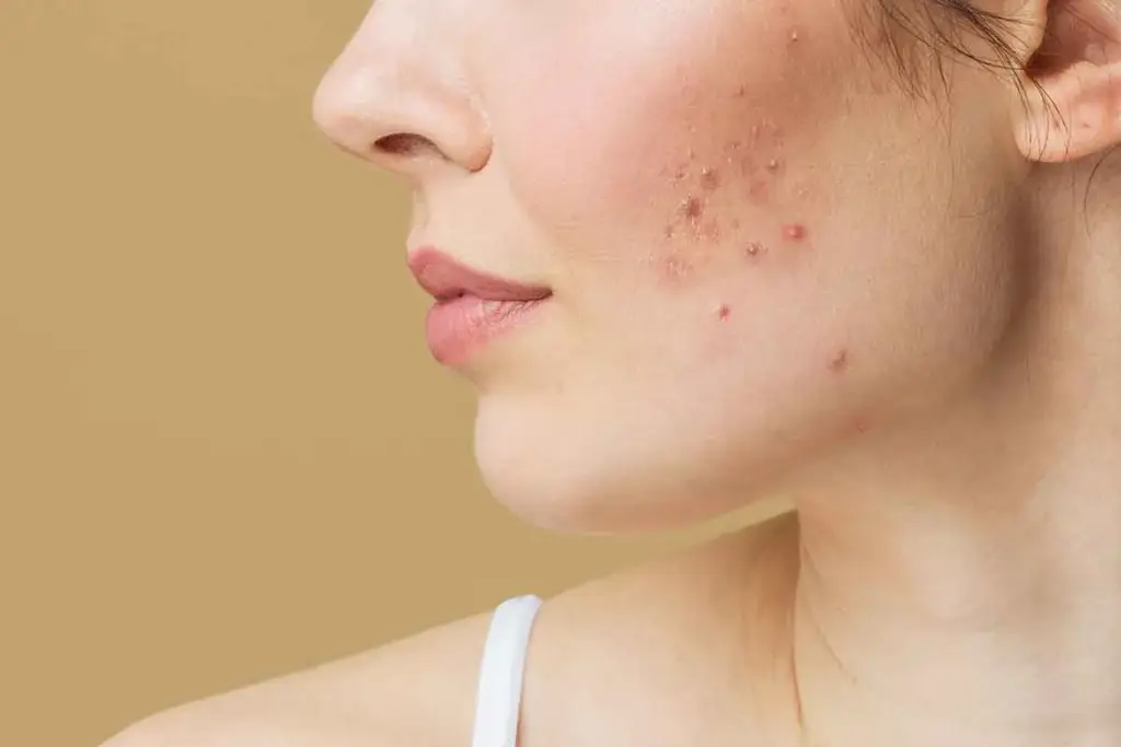 How to Get Rid of Acne Scars Naturally at Home
