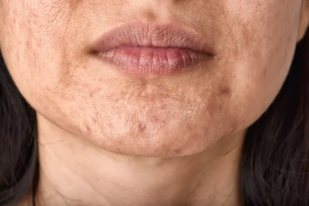 Does Exfoliating Help Remove Scars and Improve Skin?