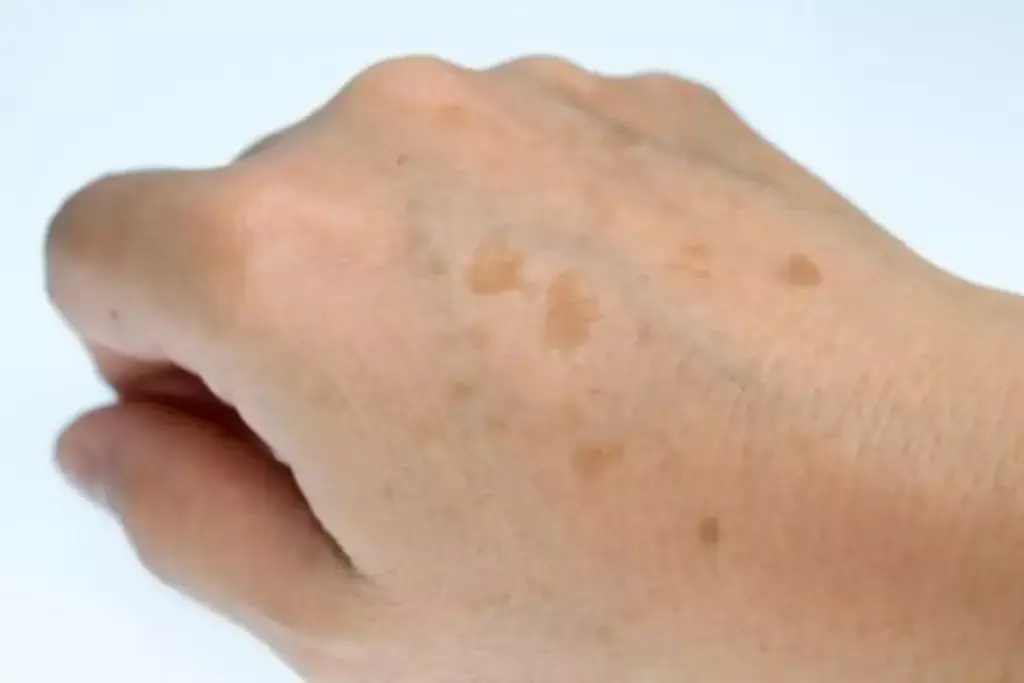 How to Remove Dark Spots on Hands Naturally 1 How to Remove Dark Spots on Hands Naturally