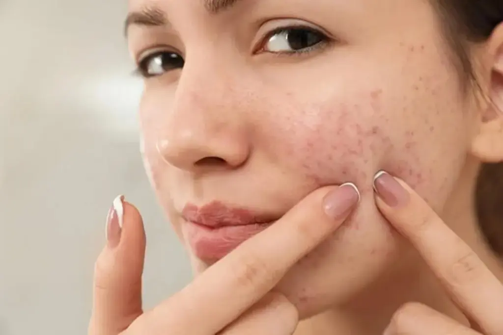 How to Remove Scars Naturally: Best Home Remedies