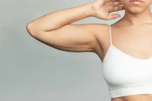 Arm Liposuction vs Brachioplasty: Which Is Right for You?