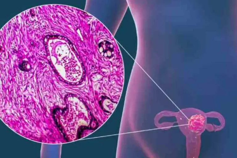 Cervical Cancer Survival Rate: Life Expectancy