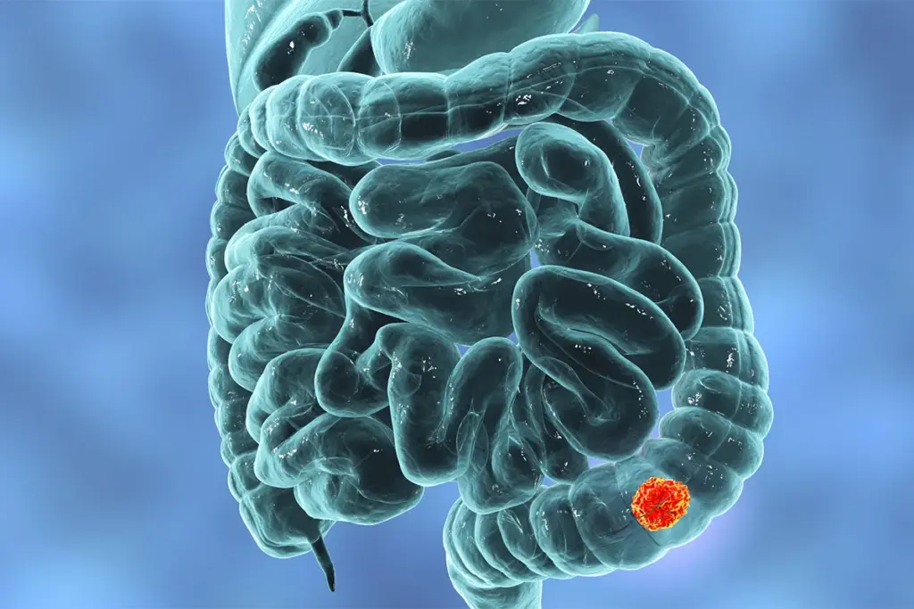 Colon Cancer Symptoms: Terminal Indicators 3 Colon Cancer Symptoms: Terminal Indicators