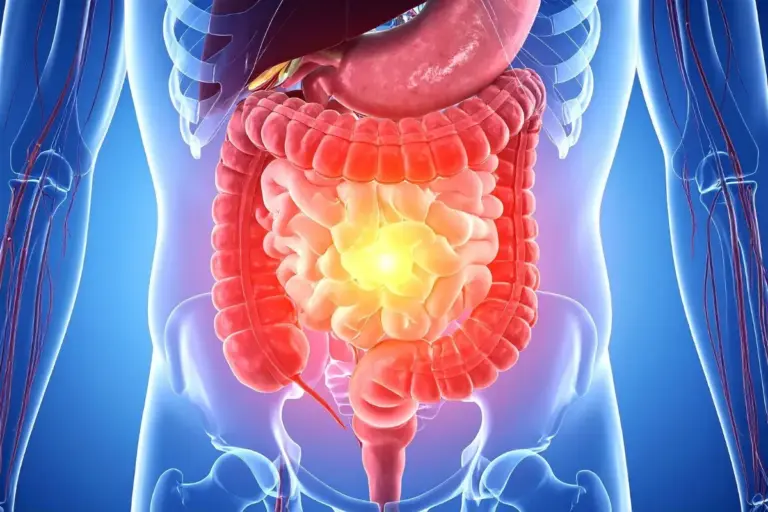 Colon Cancer Survival Rate: Top Treatments