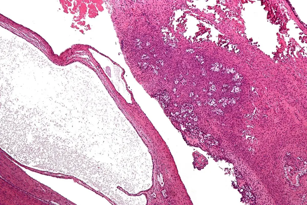 Stage 4 Ovarian Cancer: Can Spread Be Cured?