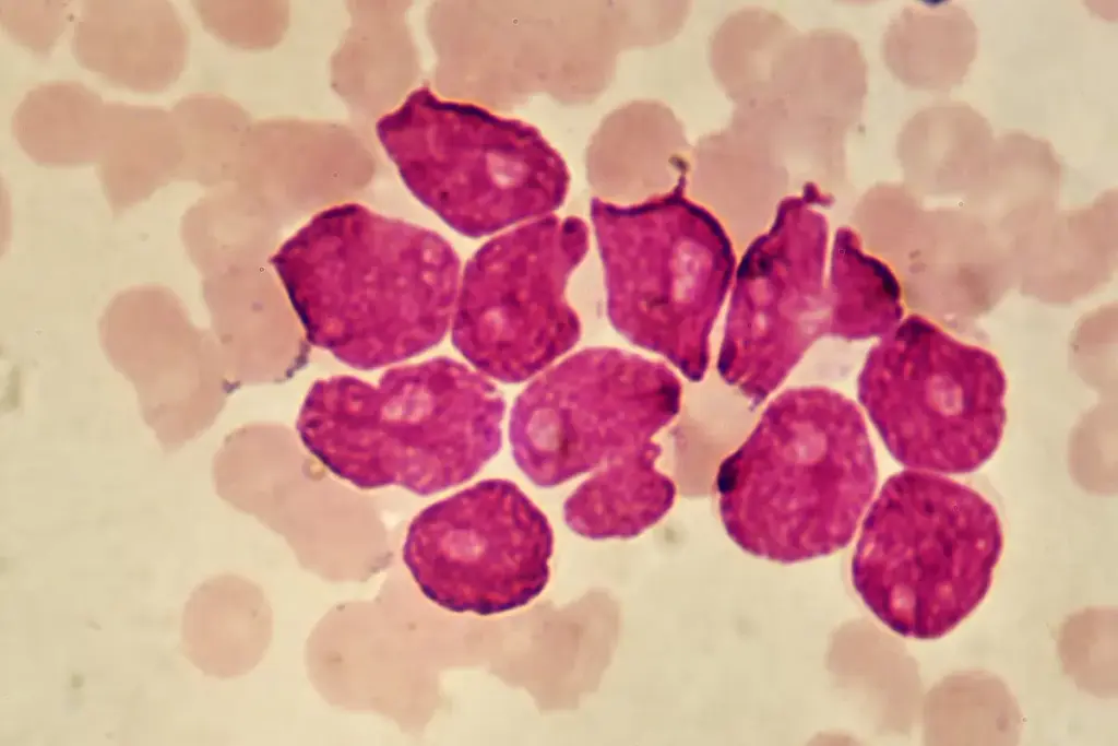 Leukemia Bone Marrow Transplant: Second Times