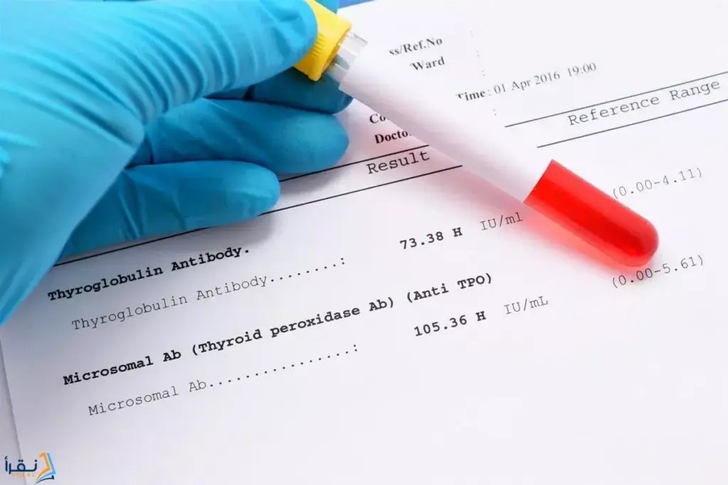 What Does High Thyroglobulin Antibody Mean?