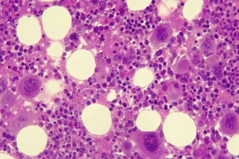 Bone Marrow Transplant: Is It Worth Having?