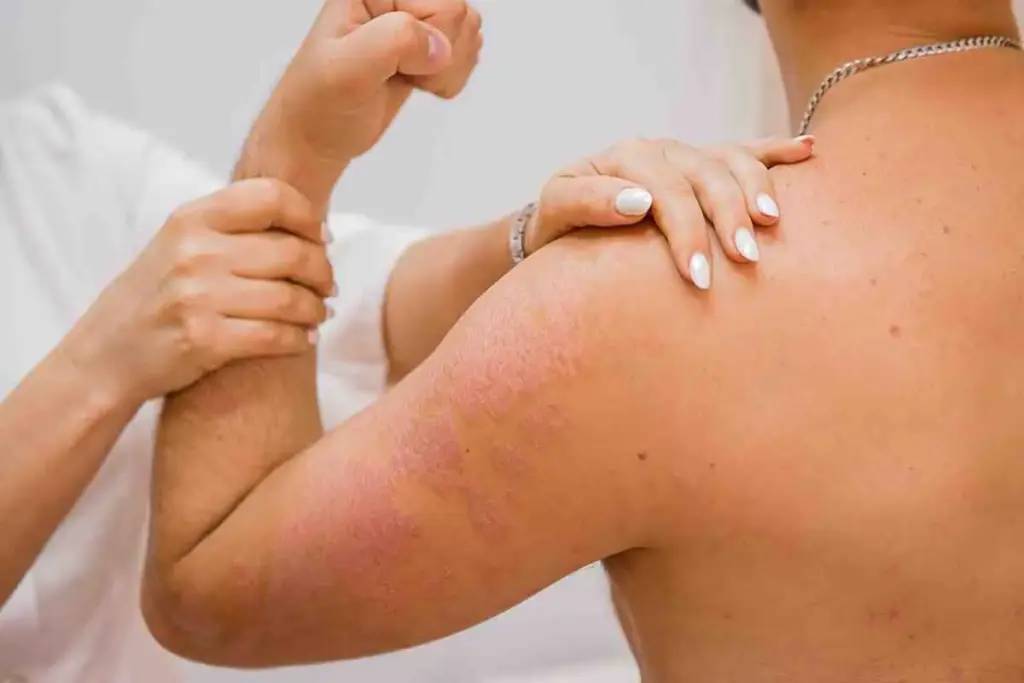What Autoimmune Diseases Cause Skin Rashes?