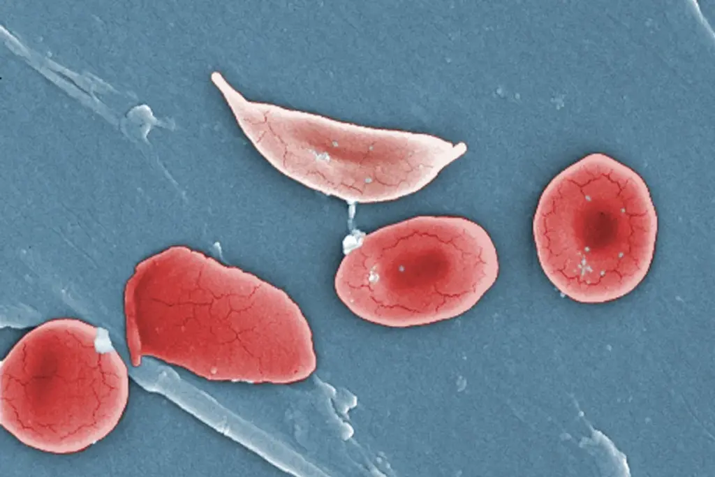 Longest Living Person With Mds: Full Life