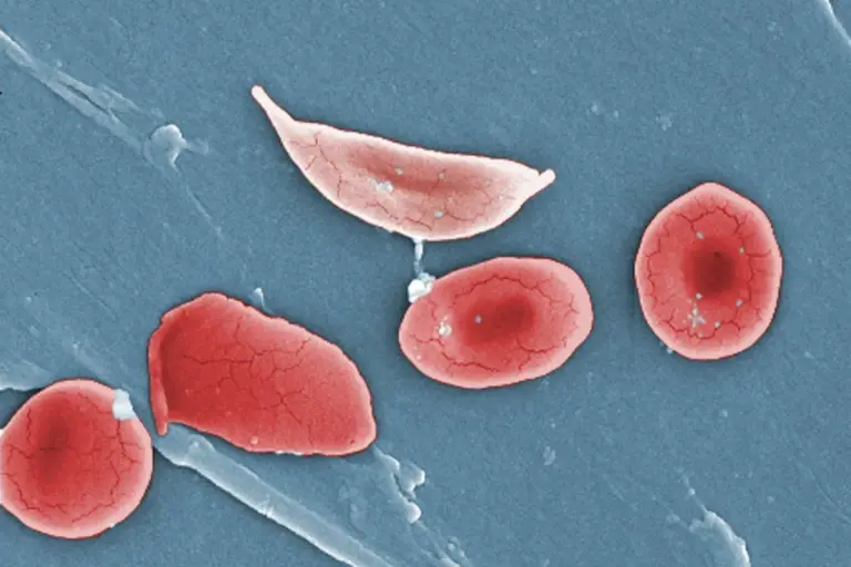 Longest Living Person With Mds: Full Life