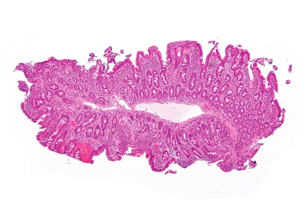 Does Celiac Disease Cause Extreme Fatigue and Tiredness?