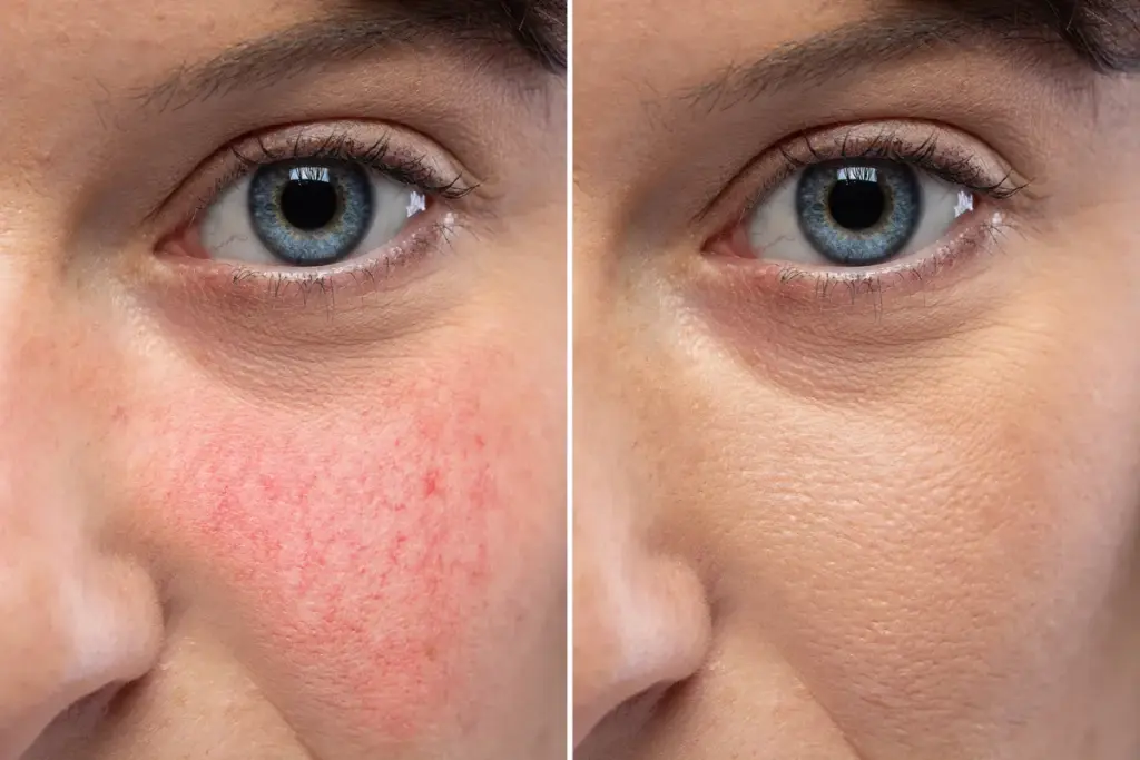 Wrinkles: What Really Works On Deep Creases?