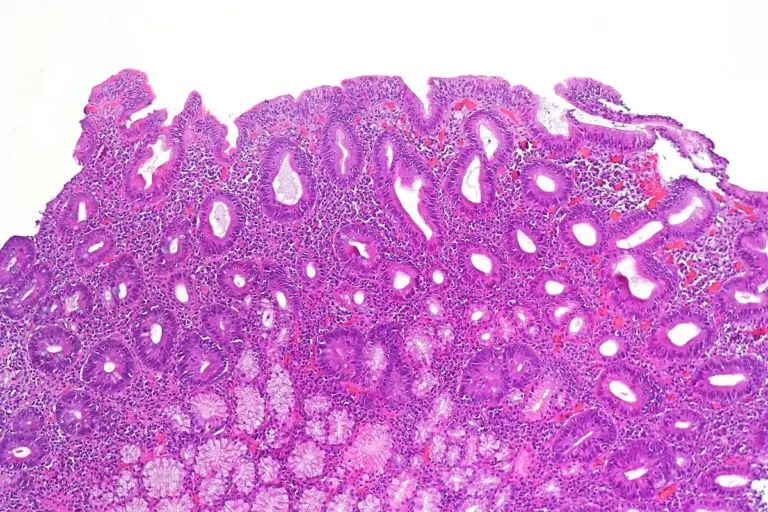 How to Diagnose Celiac Disease: Duodenal Biopsy Guide