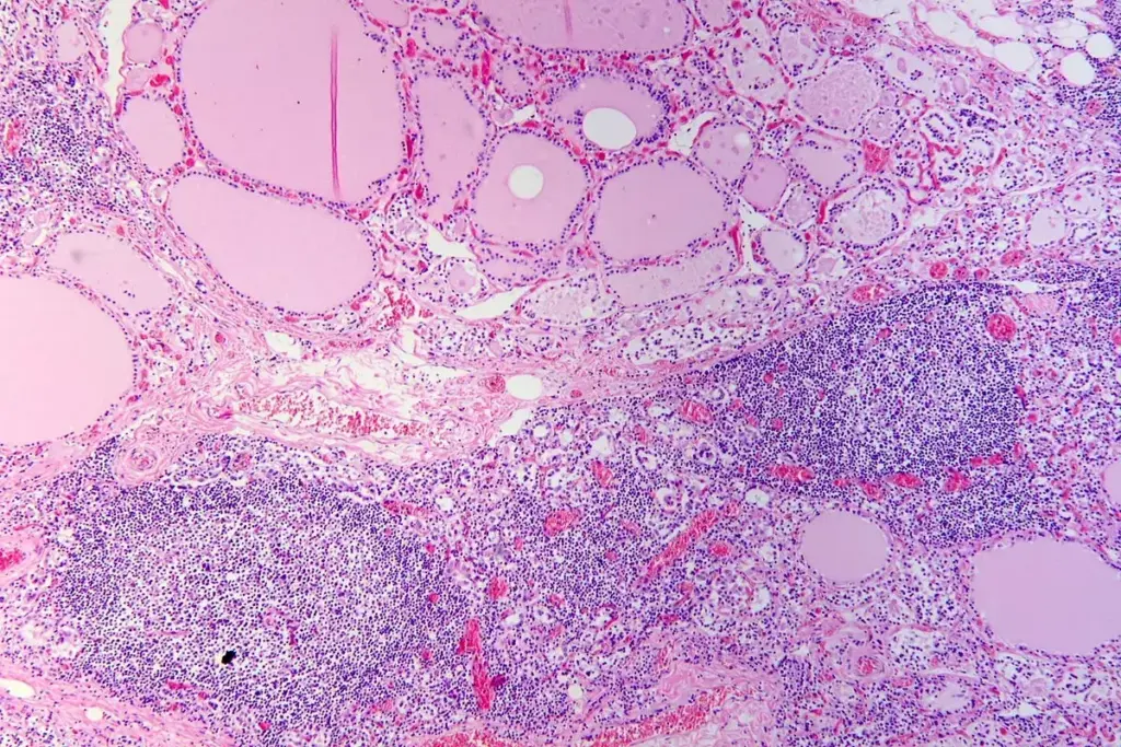 Is Hashimoto's Disease Hypo or Hyperthyroidism? 2 Is Hashimoto's Disease Hypo or Hyperthyroidism?
