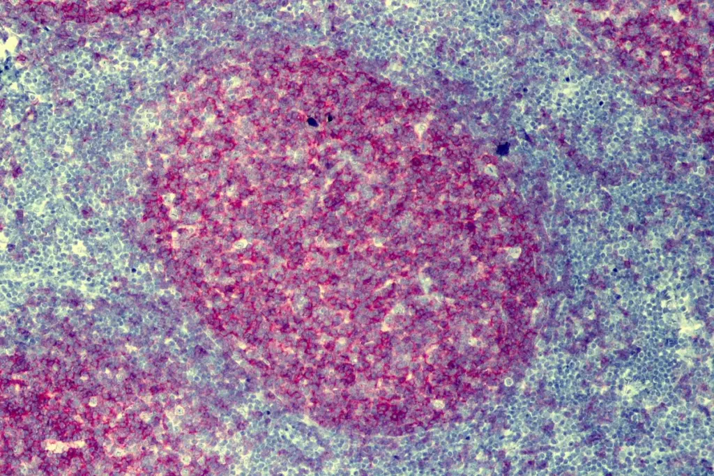 Lymphoma Symptoms: Essential Guide For Women