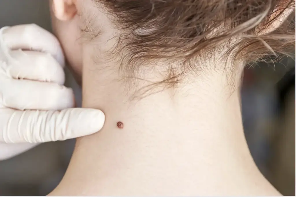Bcc: Vital Secrets Of Common Skin Cancers