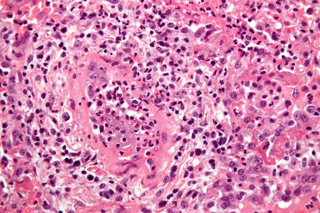 What Is Granulomatosis With Polyangiitis (GPA)?