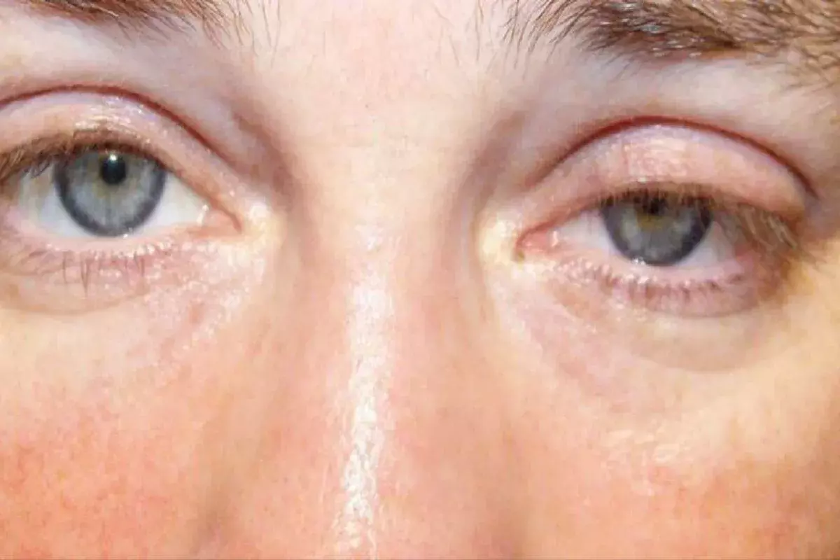 What Is Myasthenia Gravis: An Autoimmune Disease Affecting Muscles?