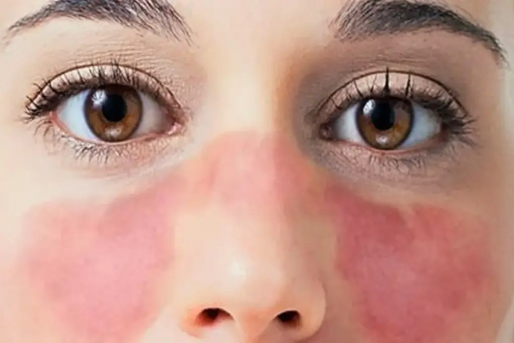How to Identify Early Signs of Lupus in Females