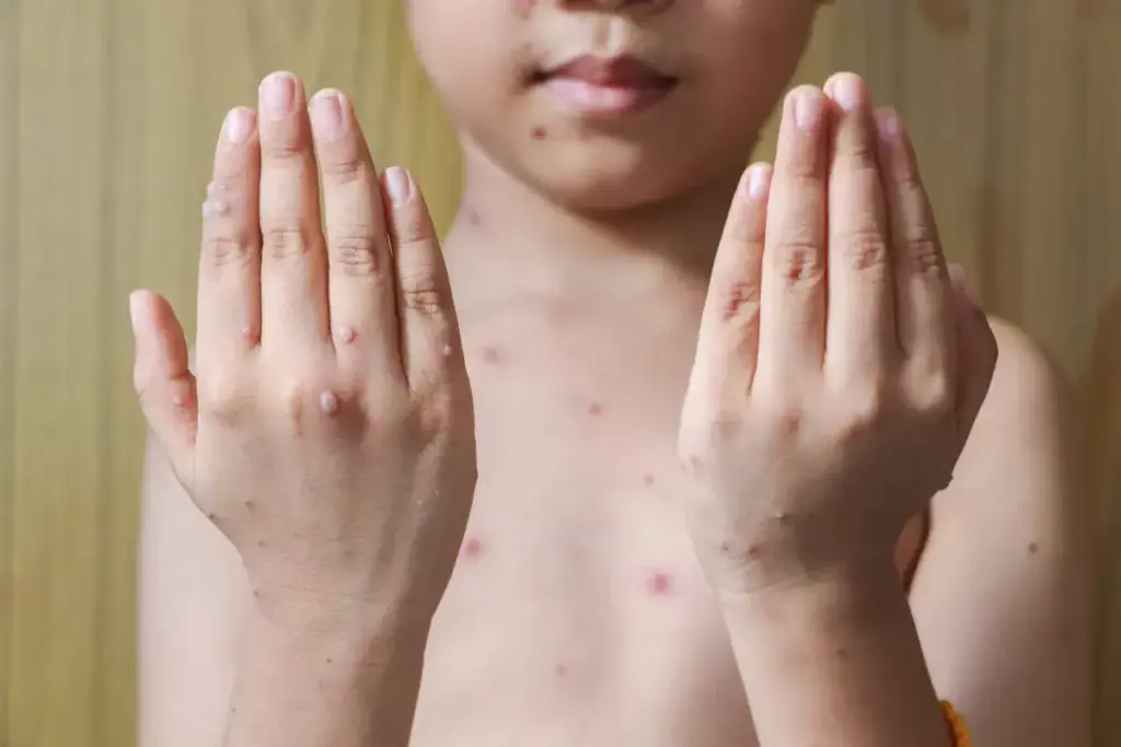 What's the Difference Between Bug Bites and Chicken Pox?