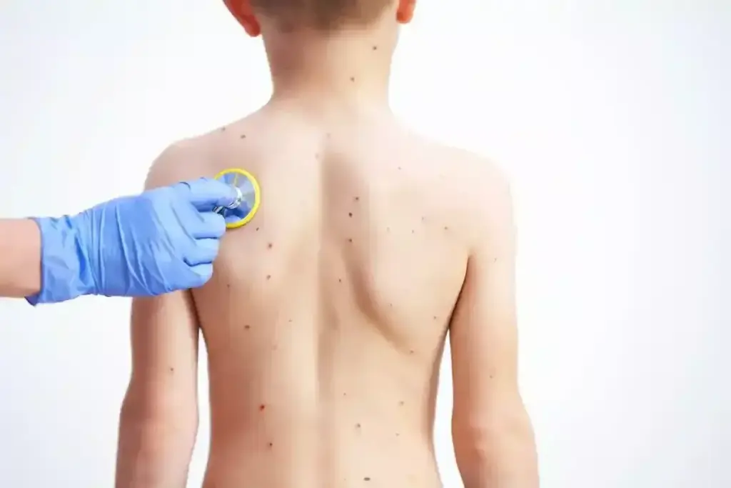 Is the Shingles Vaccine the Same as the Chickenpox Vaccine?