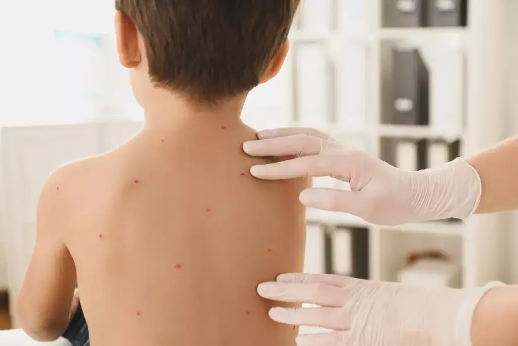 Can You Get Chickenpox After Being Vaccinated?