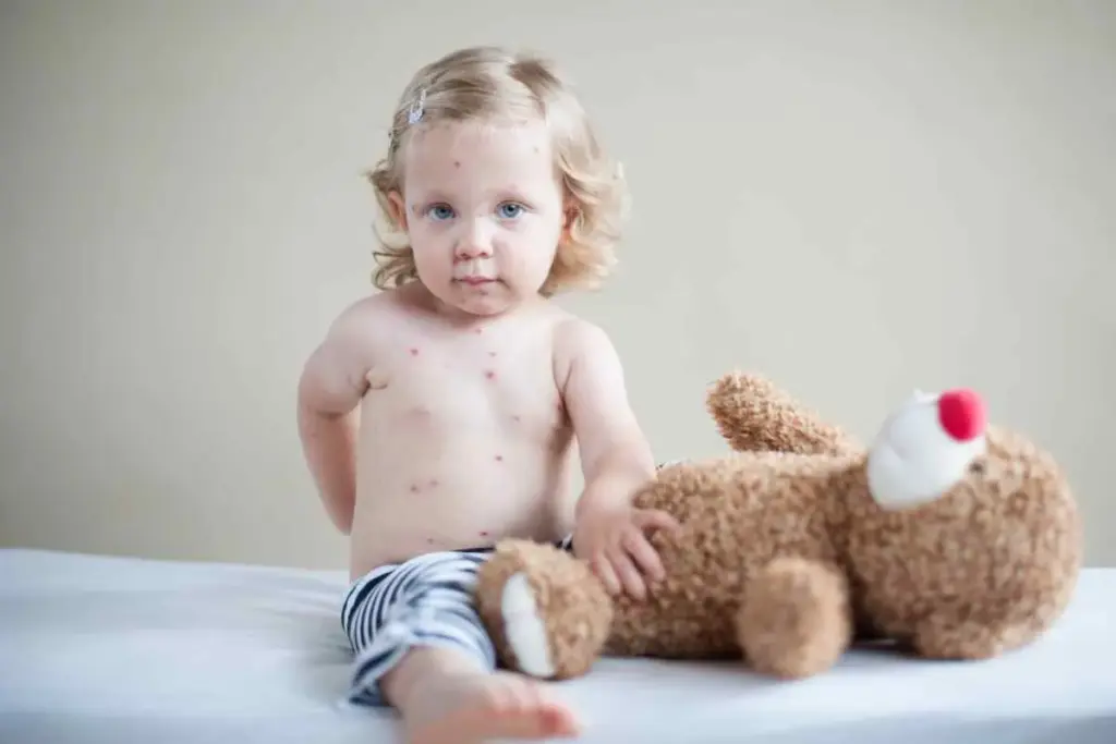 What Should Parents Know About Chickenpox in Babies Under 12 Months?