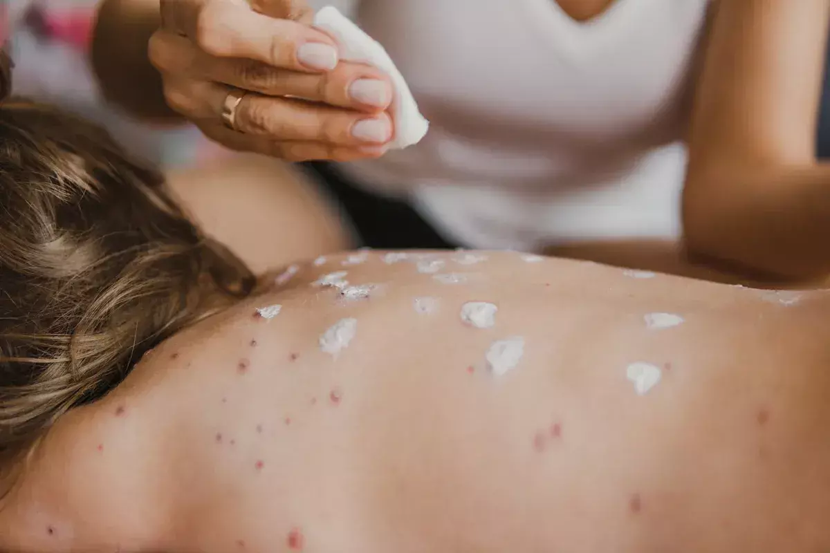 Can You Get Shingles If You Had Chickenpox?