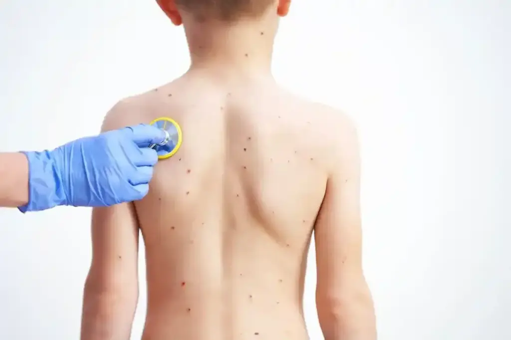 What Are the Stages of Chickenpox Progression and Varicella Rash Symptoms?