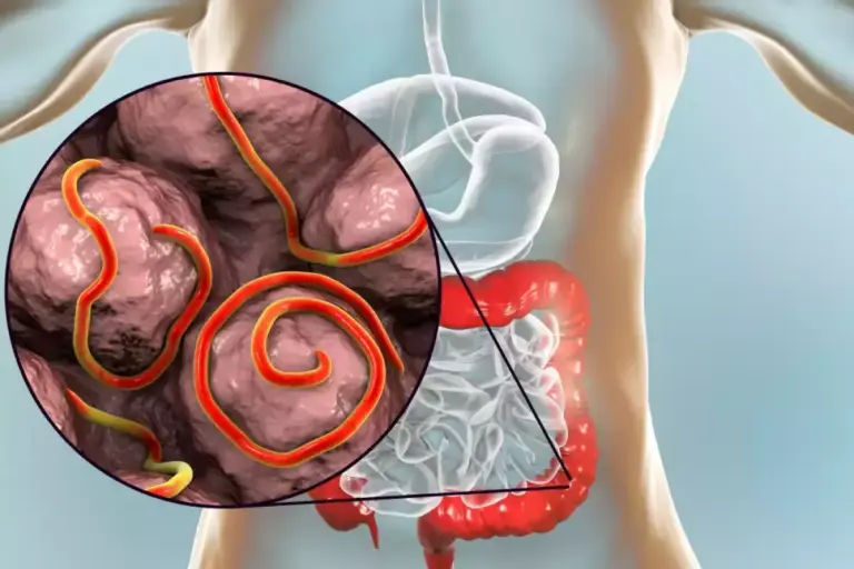 21 Signs You Have Parasites: Symptoms to Watch For