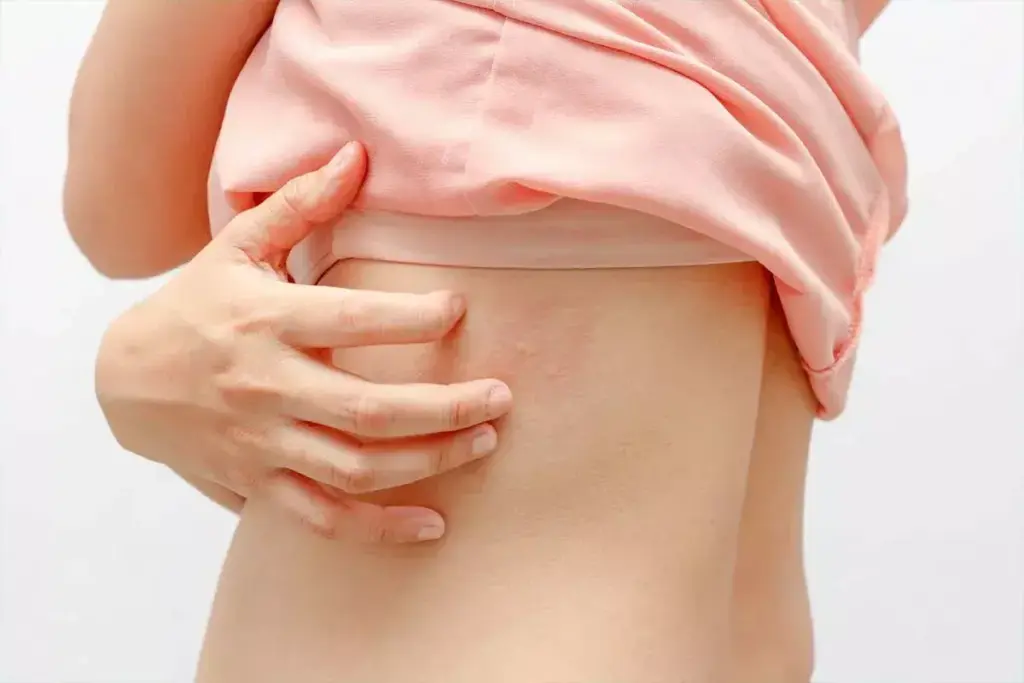 Can You Breastfeed With Shingles After Pregnancy?