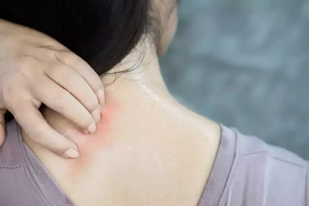 How Long Is Shingles Contagious and When Does It Stop Spreading?