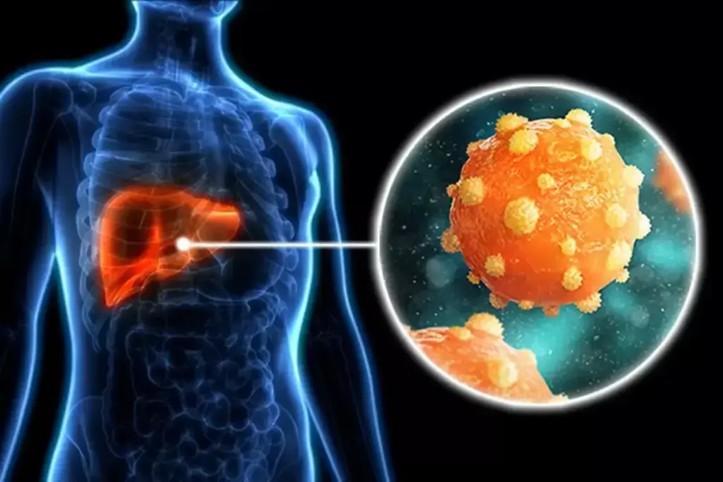 Does Hepatitis B Cause Liver Cancer?
