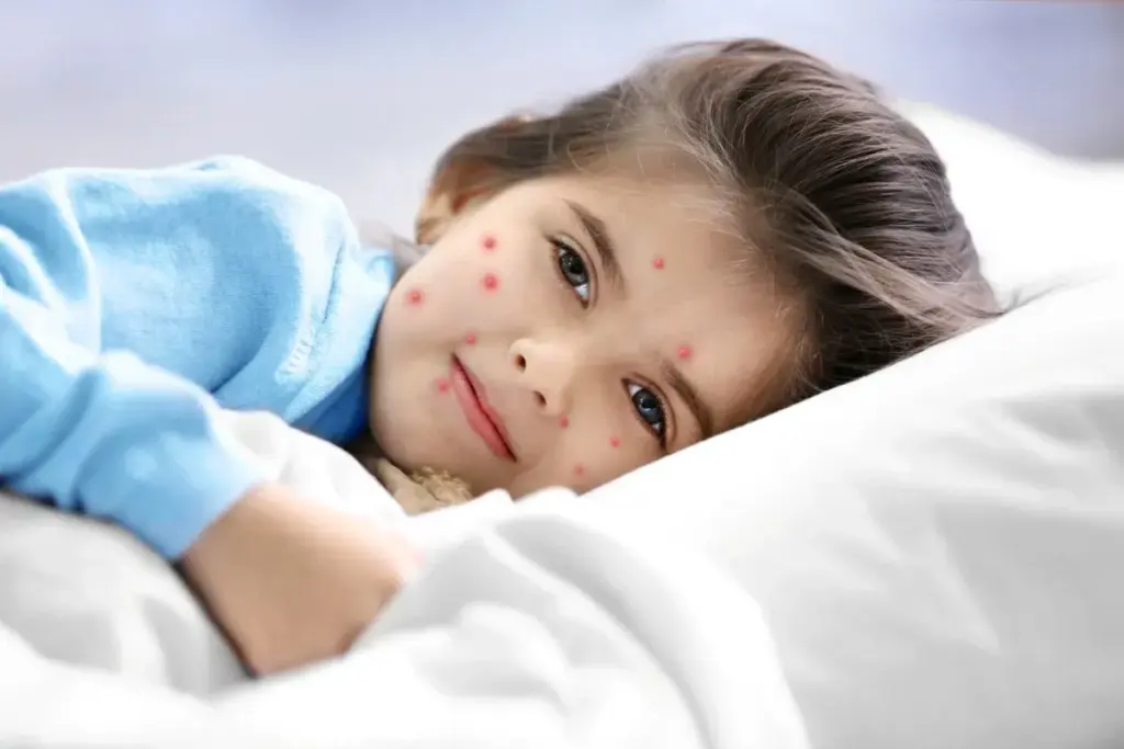 What Rash Looks Like Chickenpox But Isn't? Viral Rash Guide