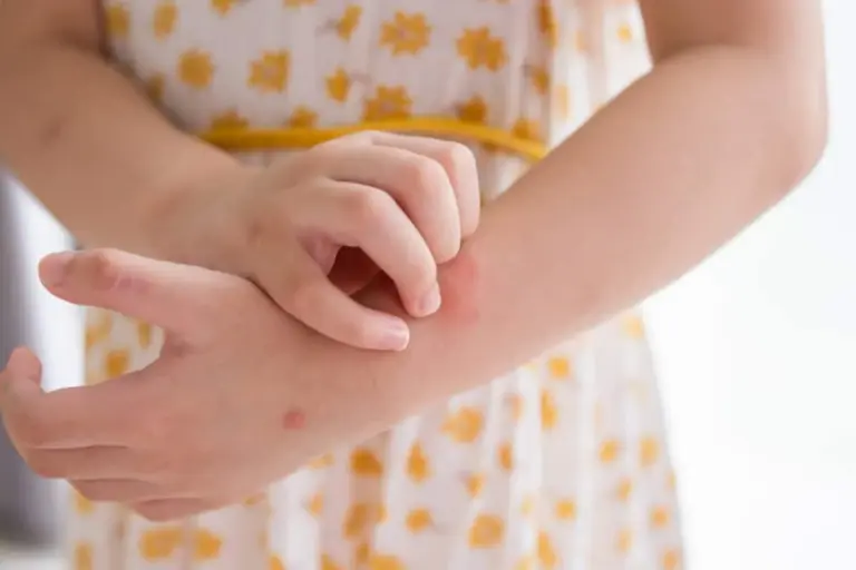 How to Identify Rashes on Kids: Guide for Parents