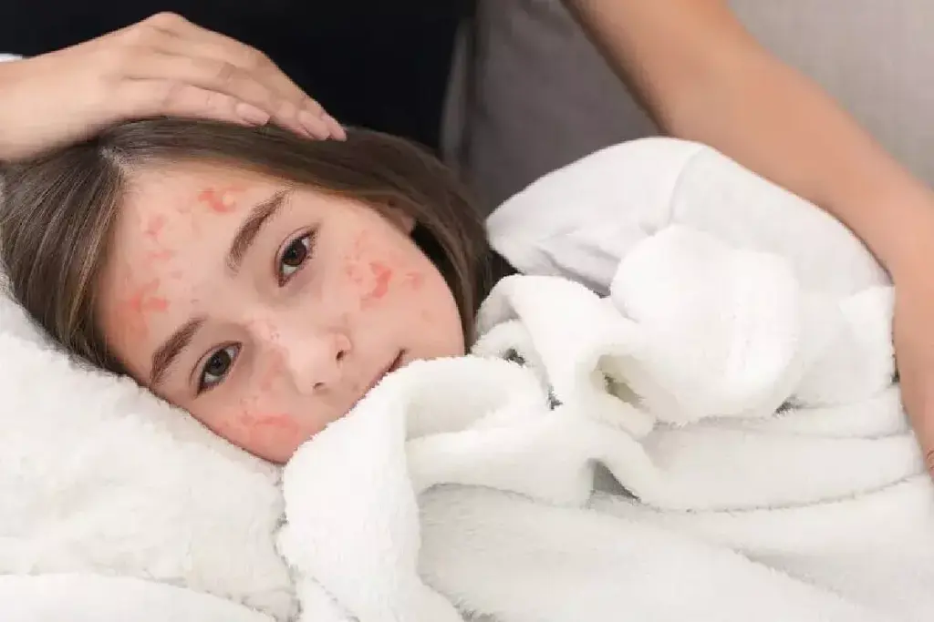 Measles Cases in US: Current Outbreaks & Deaths